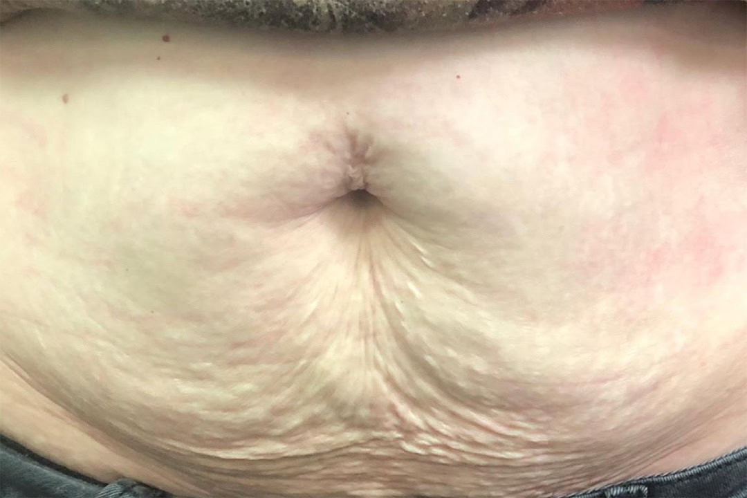 Before RF Skin Tightening