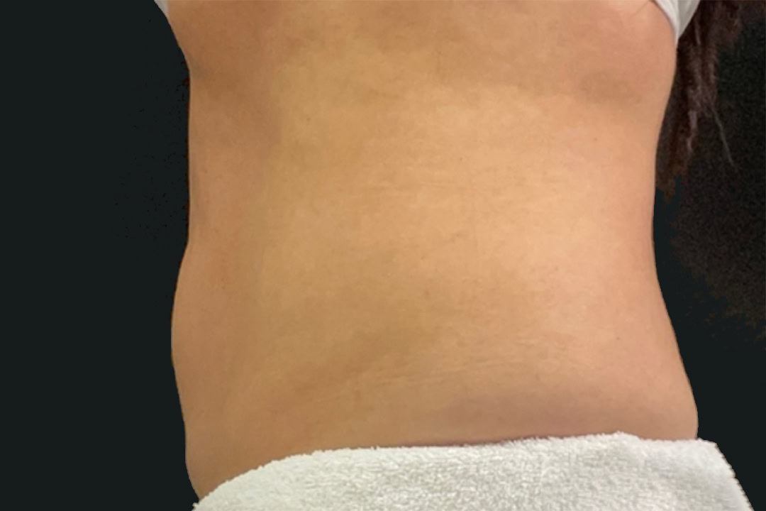 After Cryolipolysis