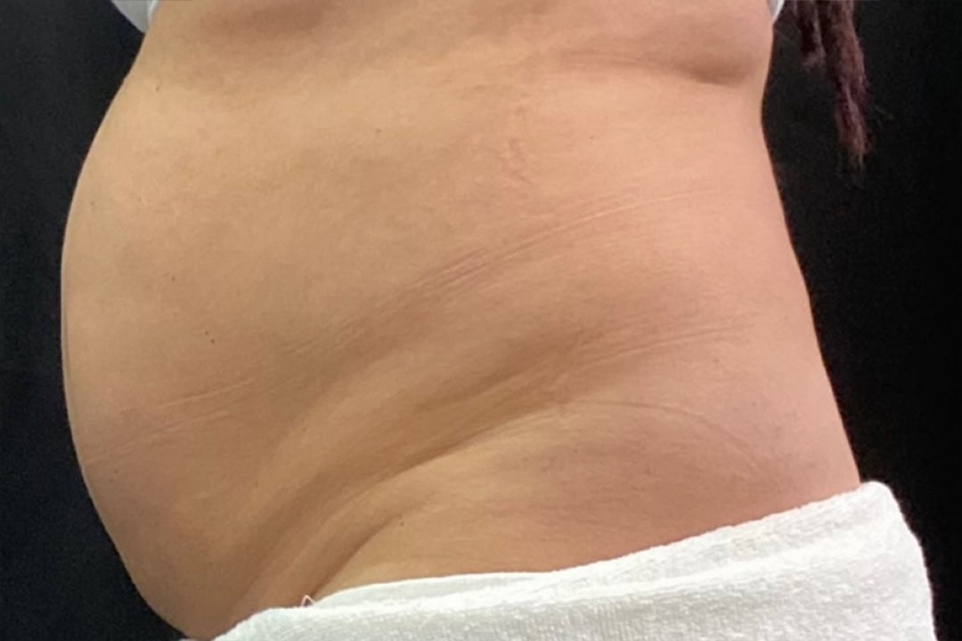 Before Cryolipolysis