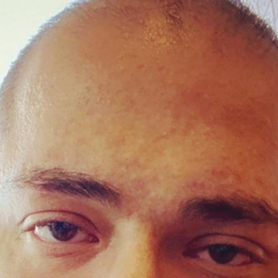 After Acne Corrective Facial