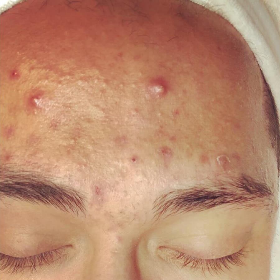 Before Acne Corrective Facial