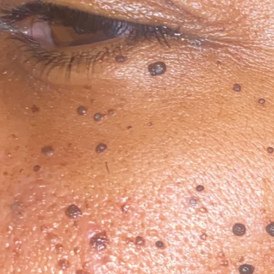 After Dark Spot Removal