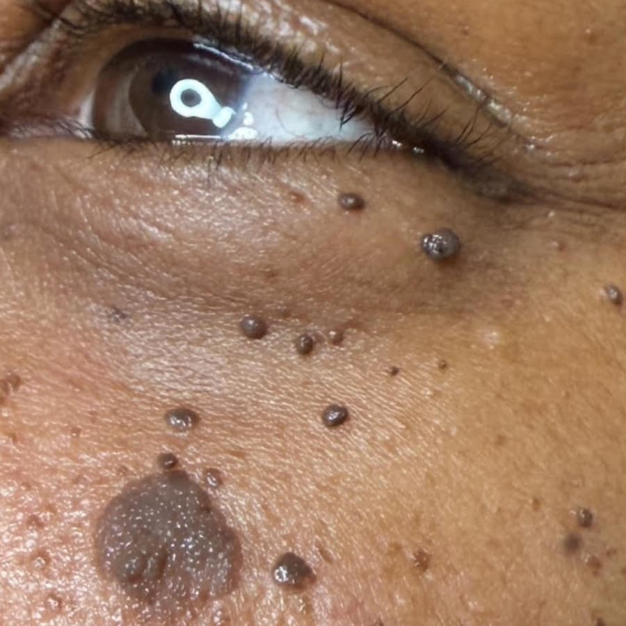 Before Dark Spot Removal