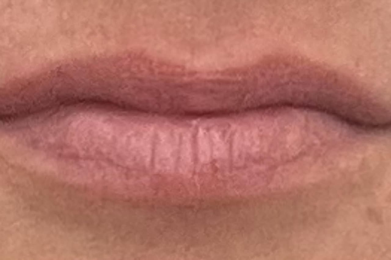 Before Microneedling